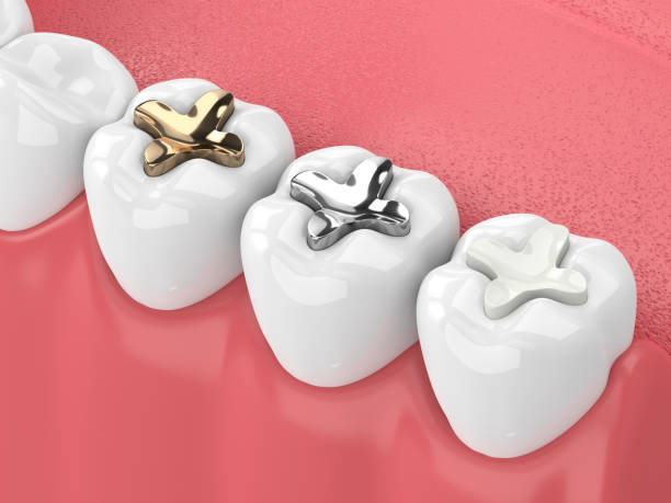 Dental Fillings: Everything You Need to Know about These Restorative Dentistry Procedures